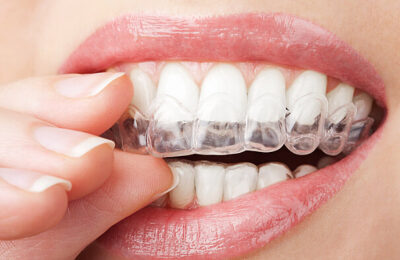 How Often Should You Undergo Teeth Whitening Procedure?